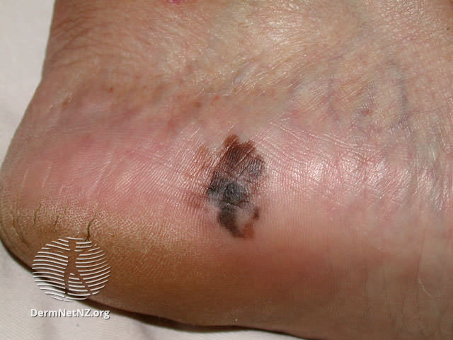 Acral lentiginous melanoma