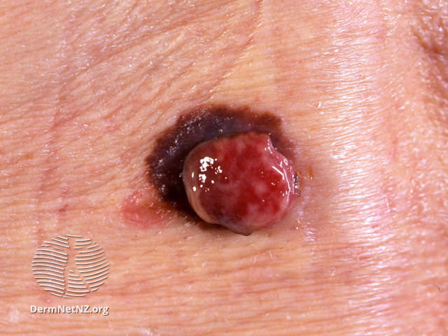 Amelanotic melanoma