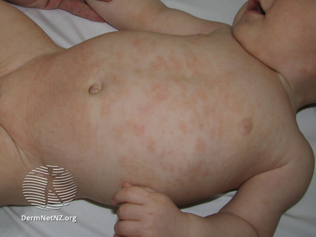Eczema, Atopic (Paediatric) – RefHelp
