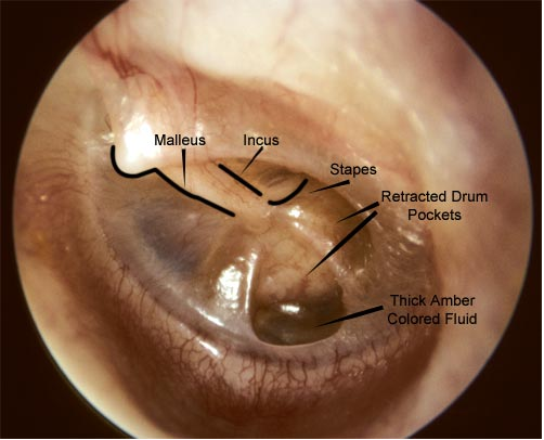 Glue Ear, Middle Ear Infections and Grommets