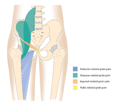 Groin pain