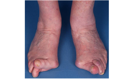 Hallux Valgus Bunions