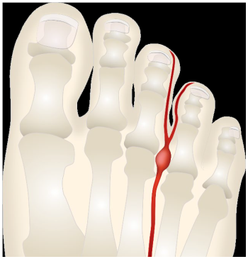 Metatarsalia & Mortons Neuroma