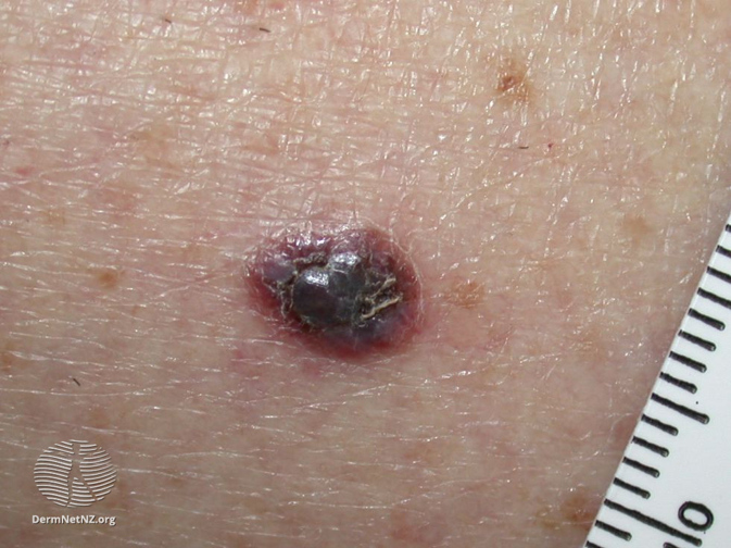 Nodular melanoma