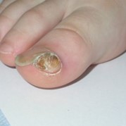 Ingrown toenail - NHS