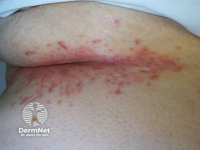 Radiotherapy DermNet1