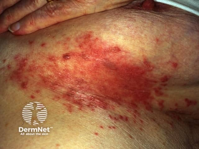 Radiotherapy DermNet2