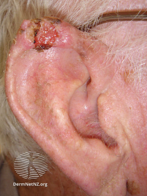 SCC Ear