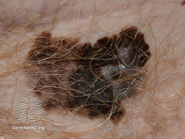 Superficial spreading melanoma